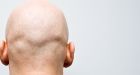 Calling a man bald counts as sexual harassment, UK judge rules