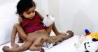 Girl born with four arms and four legs undergoes surgery in India