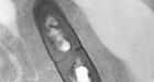 Elderly woman with listeriosis dies in N.B. hospital