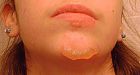 Teen burned in KFC poutine mishap