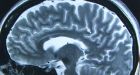 New device can suck out stroke-causing blood clots