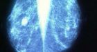 Critical review launched due to cancer biopsy mix-up