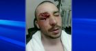 Injured Montreal student protester fights to save eye