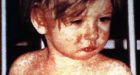 Study: US is slipping toward measles being endemic once again