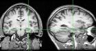 Brain pacemakers may fight depression