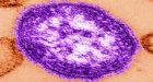 Measles outbreak reported in Metro Vancouver