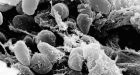 Oregon man battling 'Black Death' plague