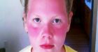 U.S. mom angry after kids sunburned during field trip